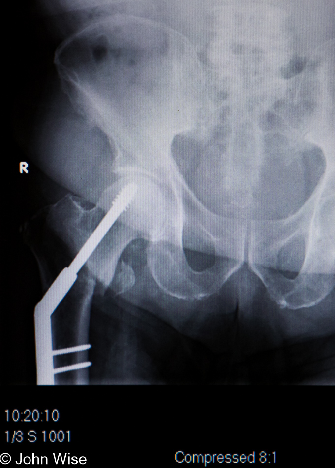 Xray of my great uncle's hip now held together with a titanium pin after a fall which broke his 84-year-old hip