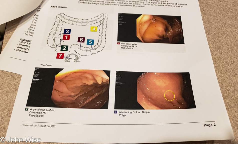 Colonoscopy