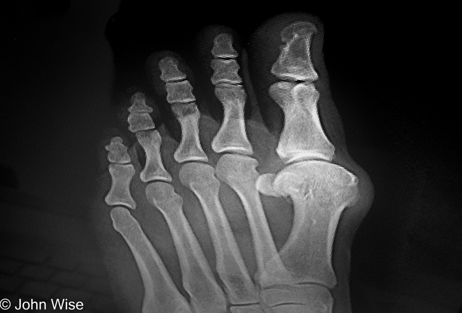 X-ray of Caroline Wise's bunion in Phoenix, Arizona