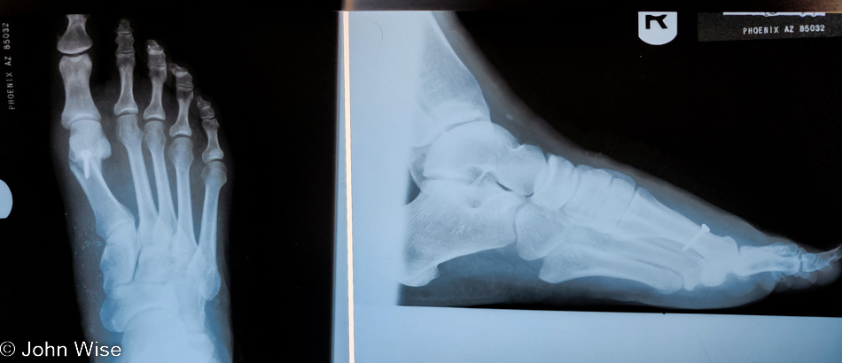 Caroline Wise x-ray of right foot in Phoenix, Arizona 